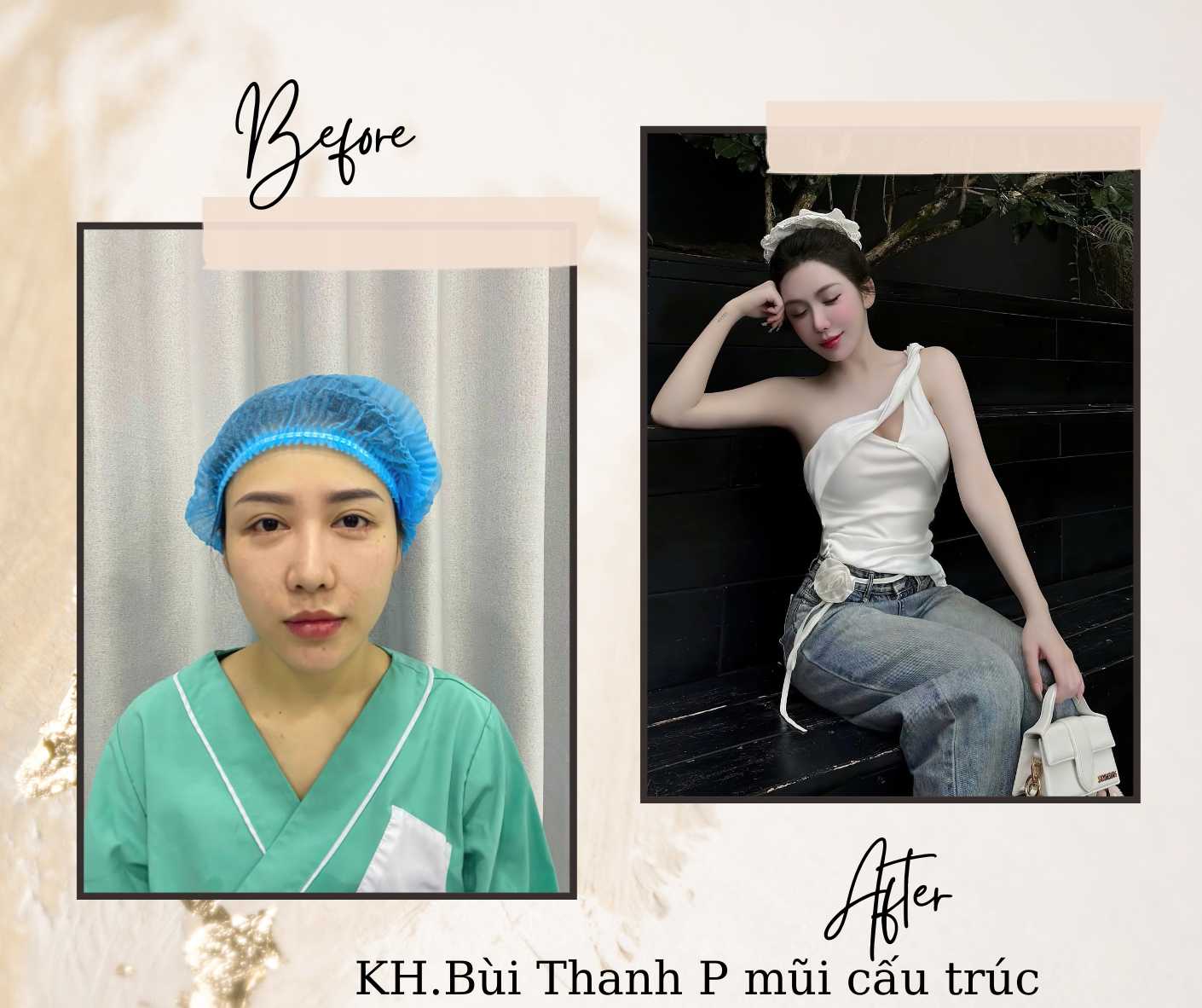 Nâng mũi bằng vật liệu độn nhân tạo kết hợp sụn tự nhiên