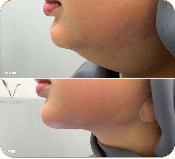 hút mỡ vùng cằm thon gọn